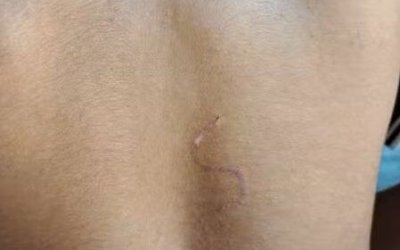 Indígena de 15 anos é queimado com marca de gado na Ilha no Bananal