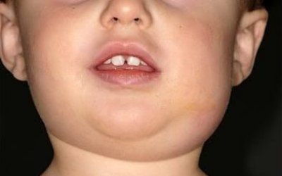 SES-TO alerta a população sobre a importância da prevenção à caxumba