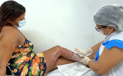 Vítima de queimadura tem saúde recuperada em tratamento no HRA