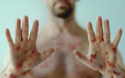 Araguaína confirma primeiro caso de varíola dos macacos