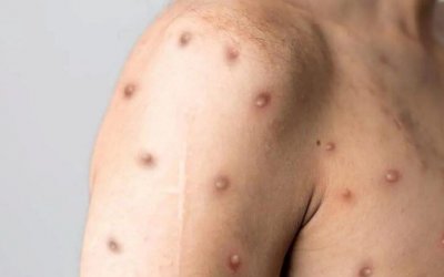 Tocantins tem 13 casos suspeitos da varíola dos macacos