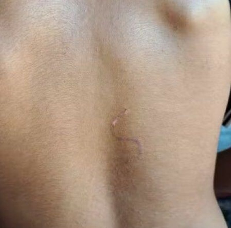 Indígena de 15 anos é queimado com marca de gado na Ilha no Bananal