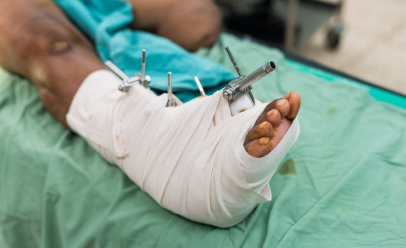 Maio Amarelo: SES-TO destaca os impactos dos acidentes de trânsito no SUS