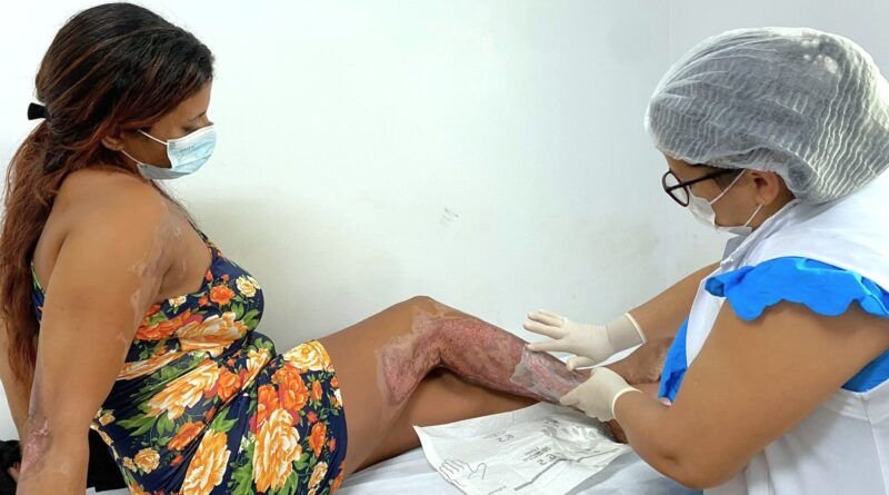 VÃtima de queimadura tem saúde recuperada em tratamento no HRA