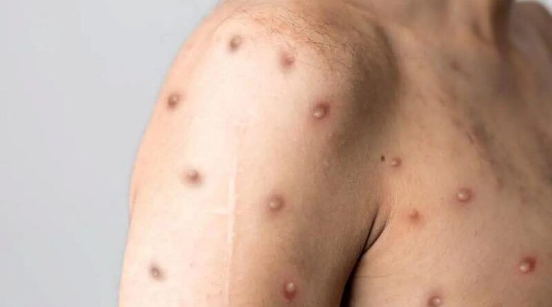 Tocantins tem 13 casos suspeitos da varíola dos macacos