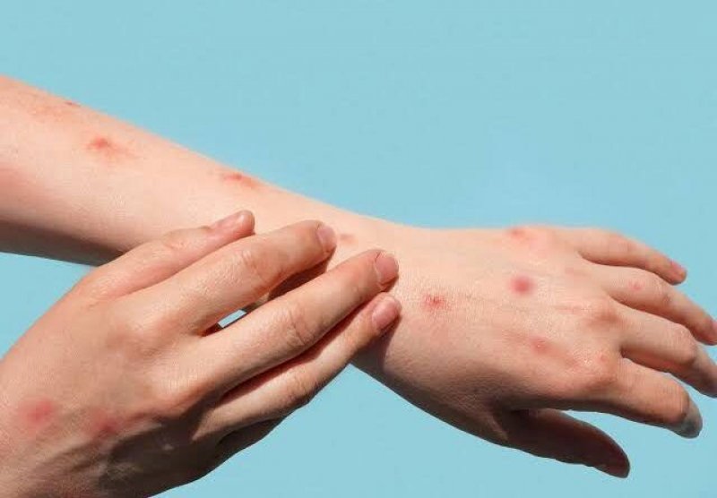 Tocantins confirma 1º caso de varíola dos macacos